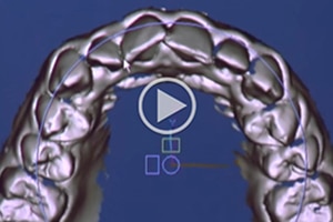 Suresmile Video at Michael Kierl Orthodontics Oklahoma City Pauls Valley El Reno OK